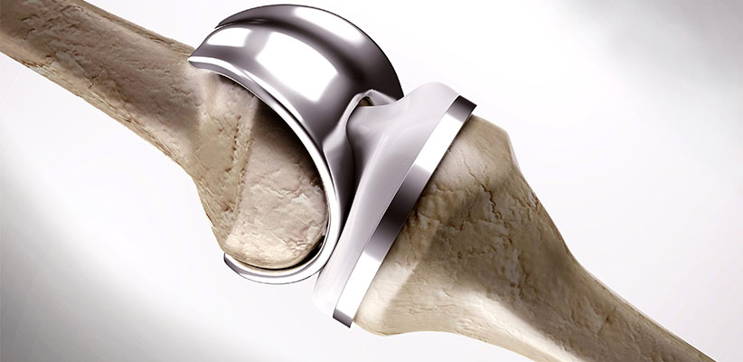 Knee Replacement